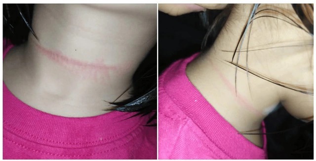 Hiểm họa từ TikTok - Vết hằn trên cổ một bé gái 4 tuổi người Philippines sau khi tham gia thử thách "Blackout" (Ảnh: YN).